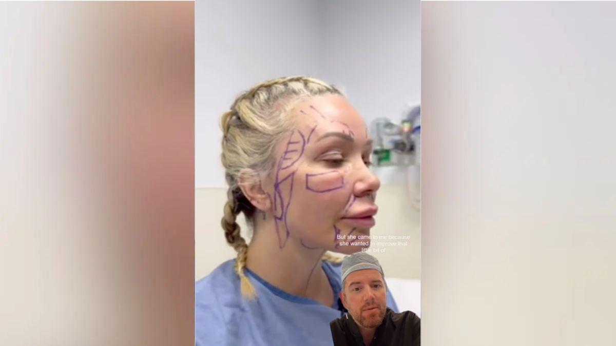 image of Her doctor confirmed the bruising and swelling are normal parts of healing.