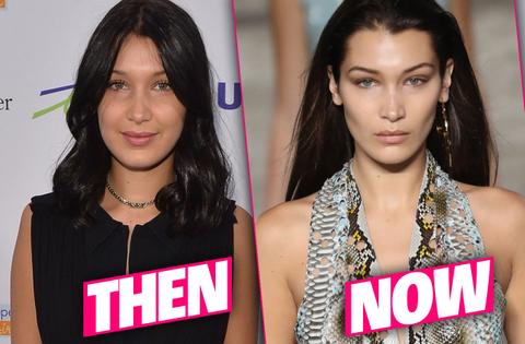 Bella Hadid Plastic Surgery Makeover Exposed By Top Doctors