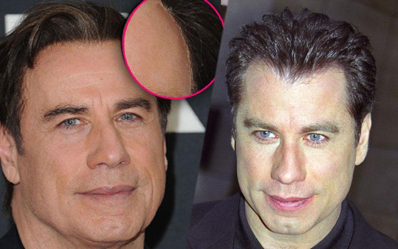 Celebrities Who Are Covering Up Their Bald Spots & Receding Hairlines