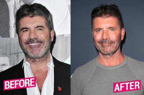 Simon Cowell Plastic Surgery Makeover Exposed By Top Docs