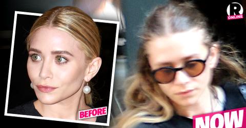 Ashley Olsen Hair Loss Lyme Disease