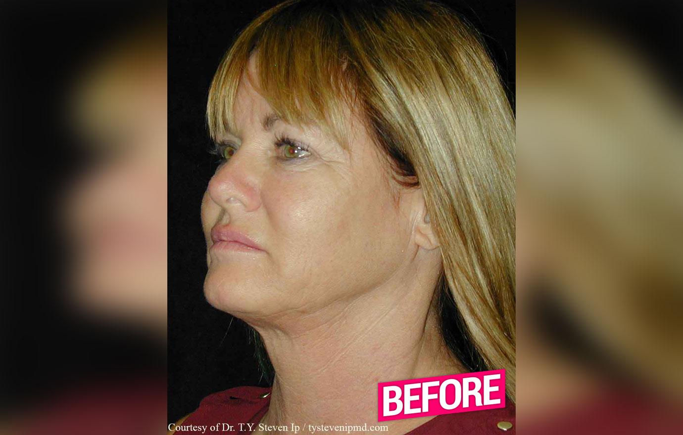 //rhoc Jeana Keough plastic surgery makeover