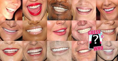 //celeb veneers wide