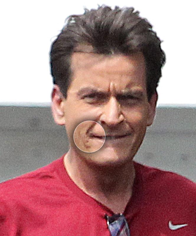 Charlie Sheen HIV Positive Lesions Face