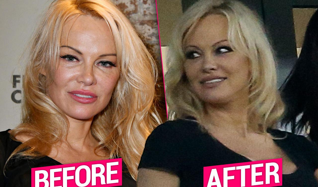 Pamela Anderson Plastic Surgery Makeover Top Docs Tel All 