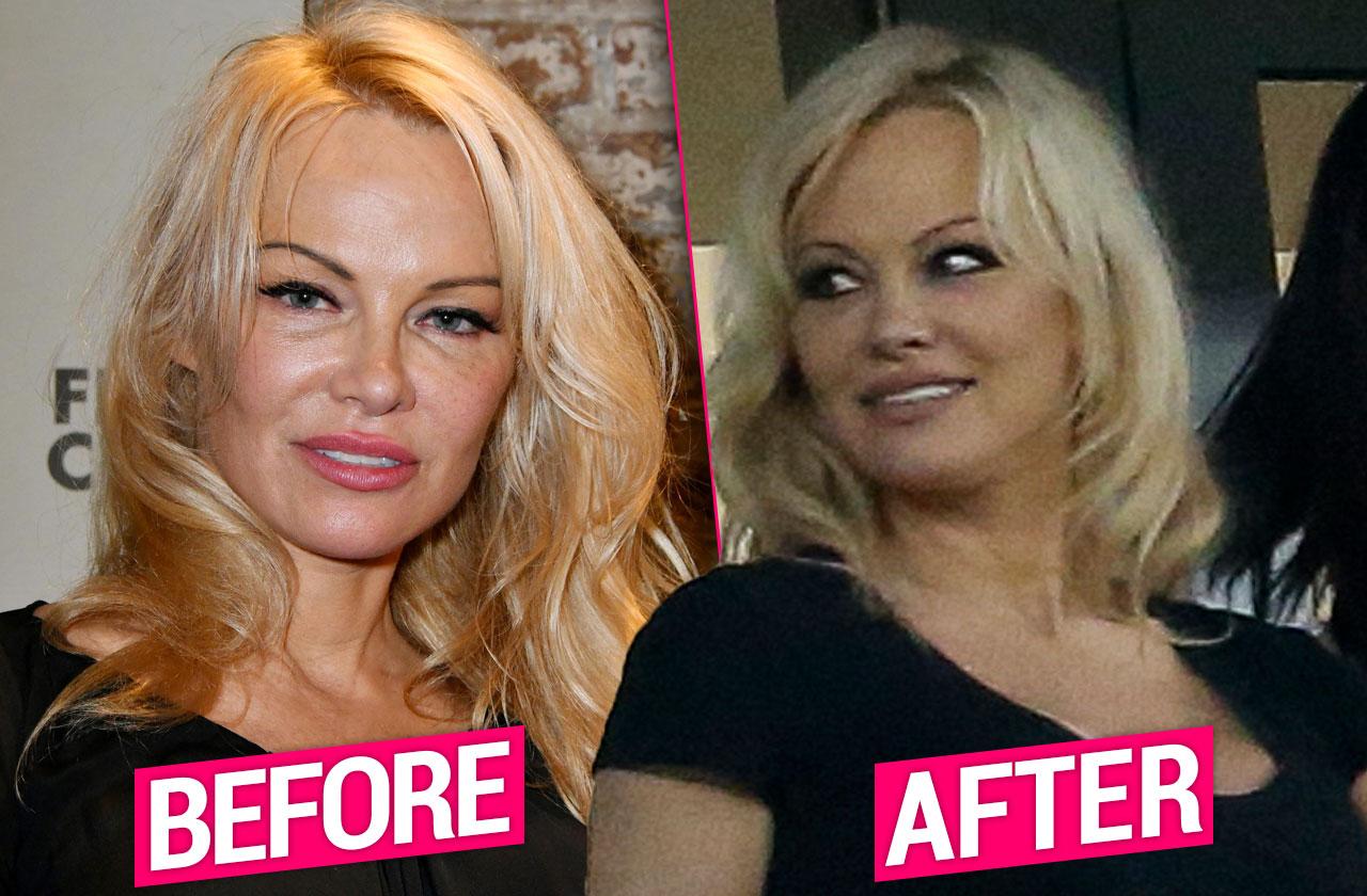 Pamela Anderson Plastic Surgery Makeover Top Docs Tel All 