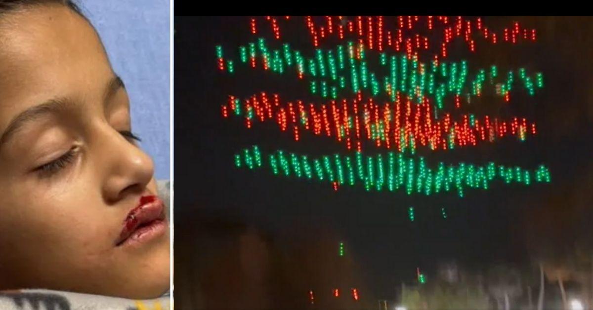 Child Underwent OpenHeart Surgery After Being Hit in Chest by Drone